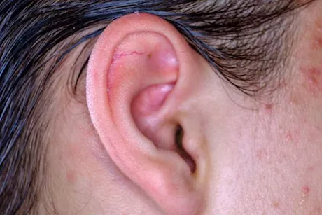 بدون أدوية.. علاجات منزلية لدماميل الأذن