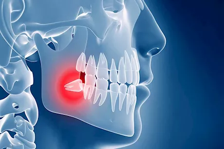 هل يجب خلع ضرس العقل دائمًا؟ طبيب يُجيب