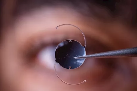 طبيب يوضح مميزات وعيوب العدسات أحادية البؤرة لعلاج المياه البيضاء