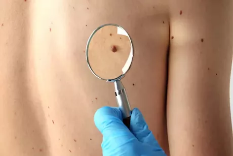 هذا ما تفعله السمنة بجلدك.. تعرف على 7 أضرار خطيرة 