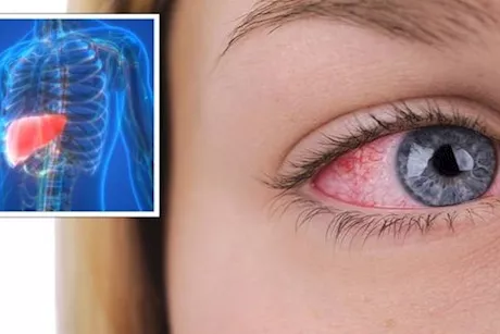 انتبه لعينيك- 8 أعراض لمرض الكبد الدهني تظهر عليهما