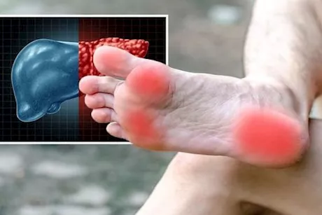 انتبه لقدميك- 6 أعراض لمرض الكبد الدهني تظهر عليهما