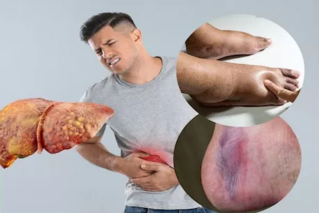 أعراض مرض الكبد الدهني المتقدم- 7 علامات تظهر على القدمين