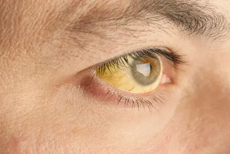 رغم سلامة الكبد- حسام موافي يوضح سبب ارتفاع الصفراء بالدم