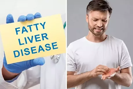 انتبه ليديك- 4 أعراض لمرض الكبد الدهني تظهر عليهما