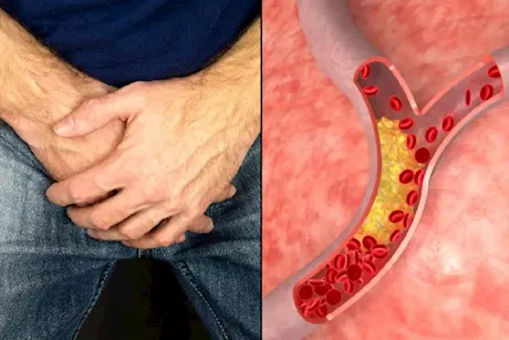 هل ارتفاع الكوليسترول يؤثر على الانتصاب؟