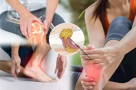 انتبه- 6 أعراض أولية تخبرك بارتفاع حمض اليوريك بجسمك