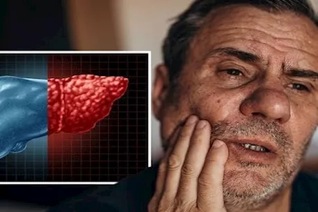 تظهر في الفم- 3 أعراض لمرض الكبد الدهني احذرها