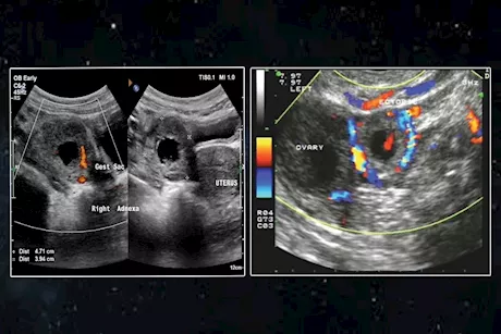 امرأة تحمل في الكبد بدلًا من الرحم.. هل سمعت بذلك من قبل؟| التفاصيل الكاملة 