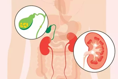 حصوات الكلى والمرارة- 4 أعراض مبكرة للتفرقة بينهما