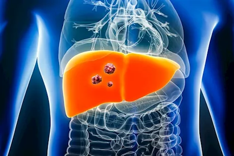 كبدك في خطر- إهمال علاج هذا المرض يصيبه بالأورام