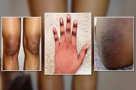 كيف تتخلصين من سواد المفاصل بطرق بسيطة وآمنة؟