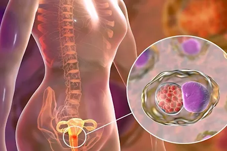 احذري- 5 علامات مبكرة تكشف إصابتك بأورام عنق الرحم