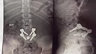 جراحة معقدة بمستشفى الشيخ زايد تنقذ طفلة من تشوه نادر بالعمود الفقري