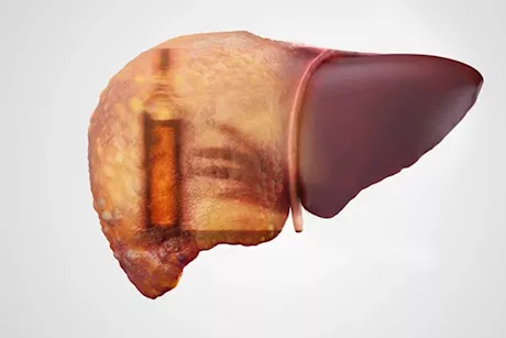 رغم تجنب الكحوليات- 9 أسباب للإصابة بمرض الكبد الدهني