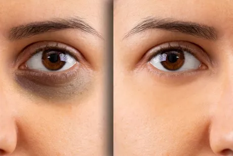 هل يقضي زيت النعناع على الهالات السوداء بفعالية؟