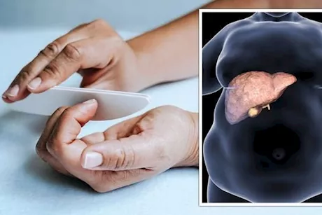 انتبه لأظافرك- 4 أعراض لمرض الكبد الدهني تظهر عليها