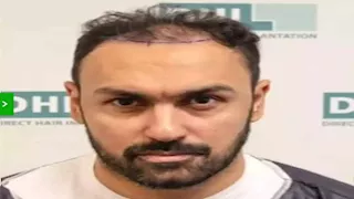 25 صورة لنجوم كرة القدم قبل وبعد زراعة الشعر