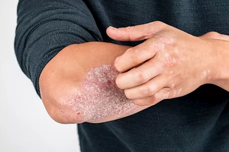 دليلك الشامل عن النظام الغذائي لمرضى الصدفية 