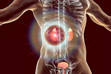 احذر- إهمال حصوات الكلى قد يعرضك لمرض خطير