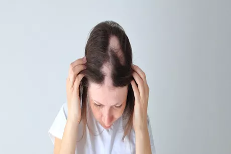 هل التوتر يسبب في الإصابة بالثعلبة؟