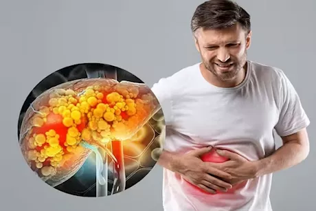 6 أسباب للكبد الدهني- هذه طرق للوقاية