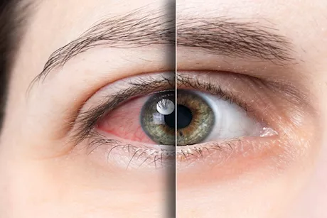 عيناك تكشفان عن نقص فيتامين د بجسمك- إليك الأعراض