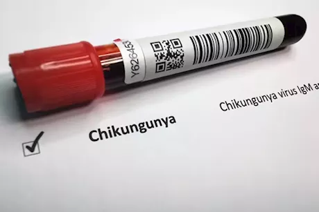 بعد انتشاره في الصين- ما هو فيروس شيكونغونيا؟ "فيديوجرافيك"