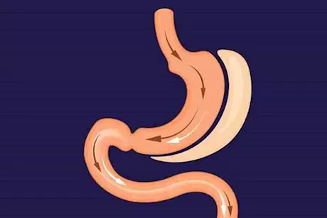 عملية تكميم المعدة للأطفال- طبيب: ممنوعة في هذه الحالة