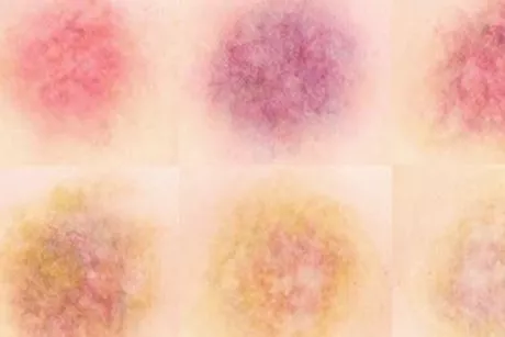 من الإصابة للشفاء- إليك المراحل التي تمر بها الكدمة "فيديوجرافيك"