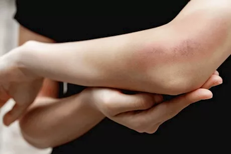 نقص فيتامين سي والكدمات- ما العلاقة بينهما؟