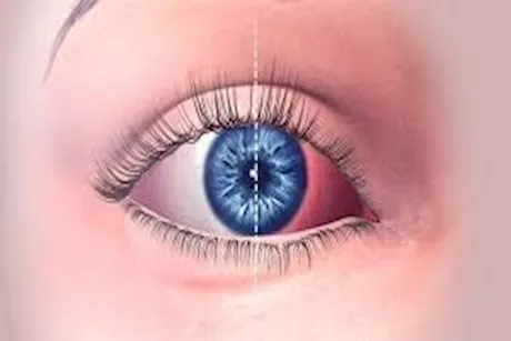 نصائح لحماية نفسك من التهاب الملتحمة في الأماكن المزدحمة