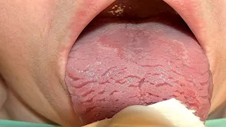 ما أسباب وأعراض وعلاج اللسان الصدفي؟