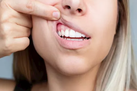 هل نزيف اللثة علامة على انقطاع الطمث؟