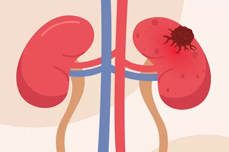 احذر- 5 أعراض مبكرة تكشف عن وجود ورم في كليتك