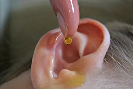 هل يمكن إزالة شمع الأذن بزبت الثوم؟