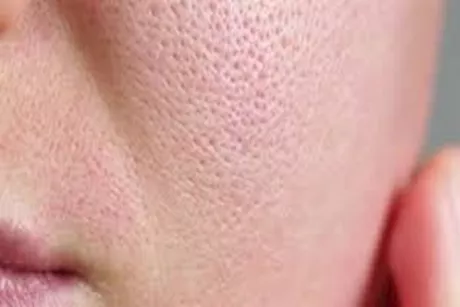 9 طرق لتقليص حجم مسام البشرة