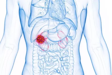 أورام الكلى التي لا يجب تجاهلها.. إليك كل ما تريد معرفته 