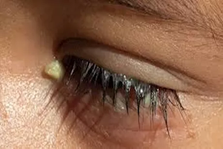 التهاب الجفن – لماذا يحدث وكيف تتخلص منه؟