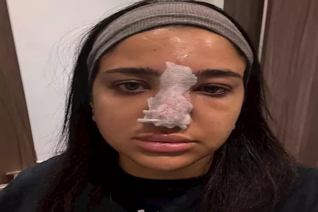 أضرار البوتوكس والفيلر.. ضحايا فخ فشل عمليات التجميل