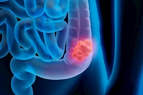 سرطان القولون منتشر بين الشباب- 6 أطعمة قد تكون السبب