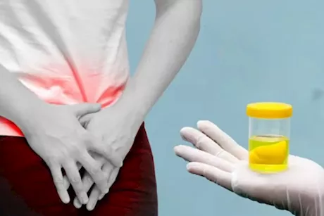 انتبه- 5 أعراض خطيرة تظهر في البول