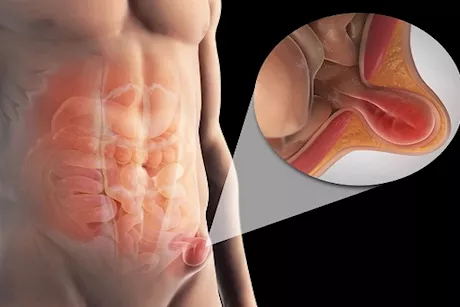 7 أنواع للفتق عند الرجال - متى تستشير الطبيب؟ 