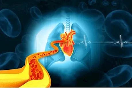 4 أسباب لإنسداد الشرايين.. طبيب يوضح