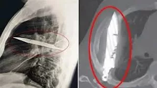 رجل يعيش 8 سنوات بشفرة سكين في صدره دون أن يدري "صور"