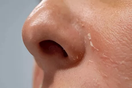 هل تعانين من جفاف الجلد حول أنفك؟ إليكِ طريقة سريعة لعلاجه