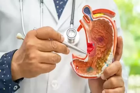 دراسة تحذر من بكتيريا الأمعاء.. قد تسبب أورام خبيثة في المعدة