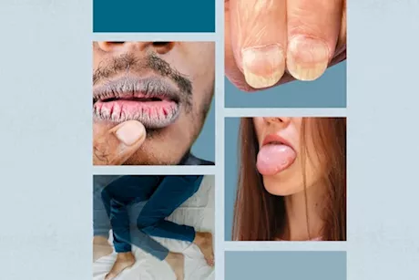 تظهر على الجلد- 6 أعراض لنقص الحديد احذرها