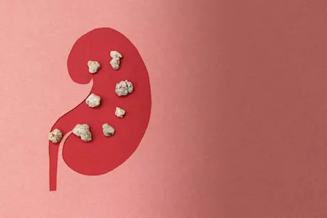 احذر- خضراوات تسبب حصوات الكلى