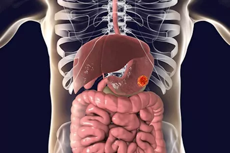 لا تتجاهلها- 5 أعراض أولية تكشف إصابتك بسرطان المعدة